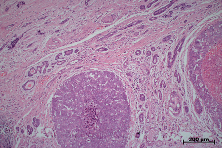 Speichelgangkarzinom