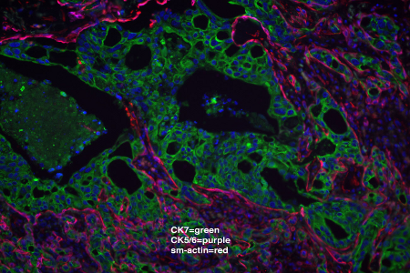 Speichelgangkarzinom